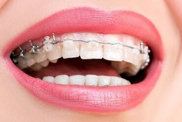 Этапы установки импланта зуба